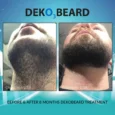 DEKO_Beard_Results